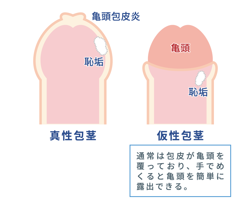 亀頭 包茎｜よつかいどう泌尿器科クリニック｜排尿障害・尿路結石のご ...